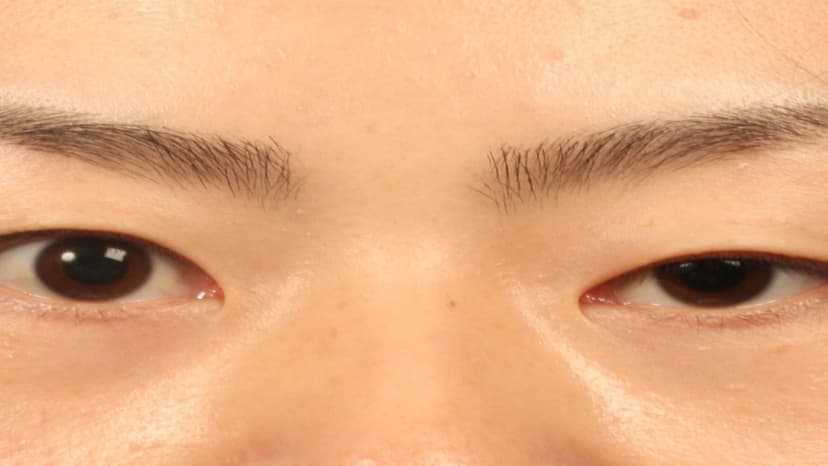 5 nguyên nhân sụp mí mắt và cách điều trị