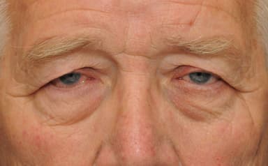 Những điều cơ bản cần biết về căn bệnh sụp mí là gì?