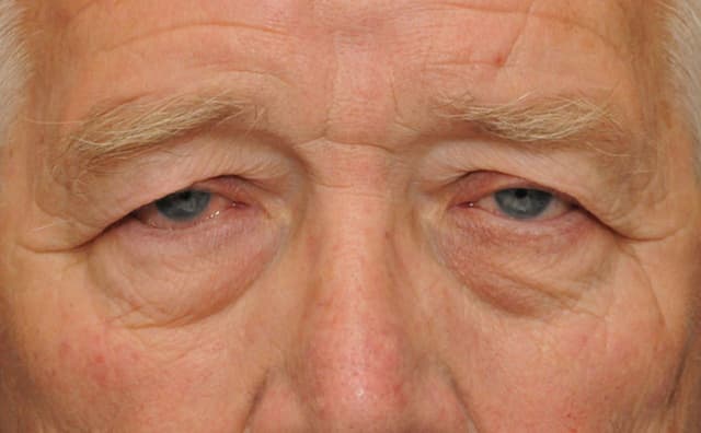 Những điều cơ bản cần biết về căn bệnh sụp mí là gì?