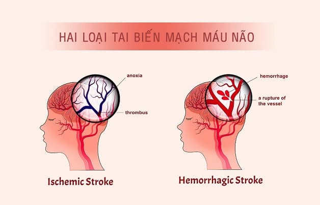 tai biến mạch máu não là đột quỵ não