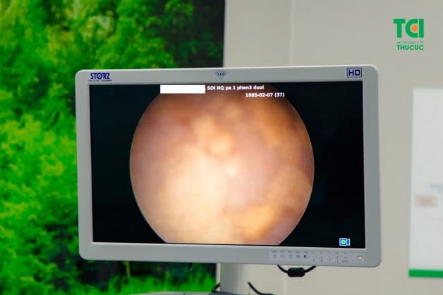 Sỏi kẹt niệu quản đoạn nội thành bàng quang là gì và giải pháp điều trị