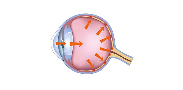 Tìm hiểu về tăng nhãn áp và triệu chứng nhận biết