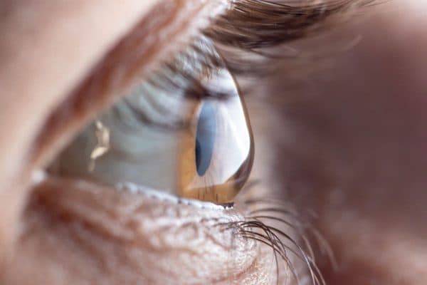 Loạn thị là tình trạng giác mạc có độ cong bất thường dẫn tới tình trạng nhìn mờ