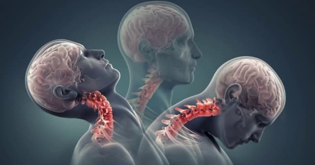 Nguyên nhân thoái hóa sống cổ và những điều bạn cần biết