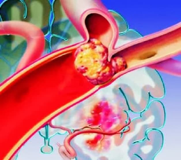 đột quỵ não do tắc mạch 