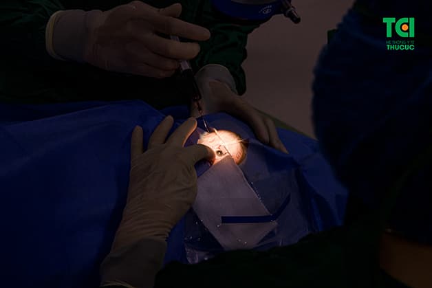 thủy tinh thể nhân tạo