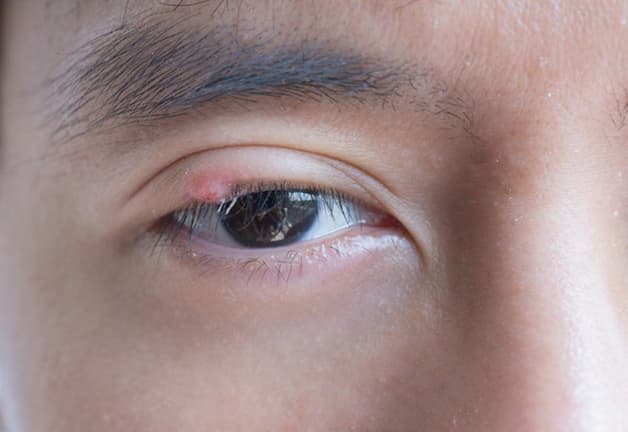 trị lẹo mắt