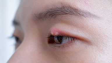 5 nguyên tắc trị lẹo mắt, ai cũng cần biết