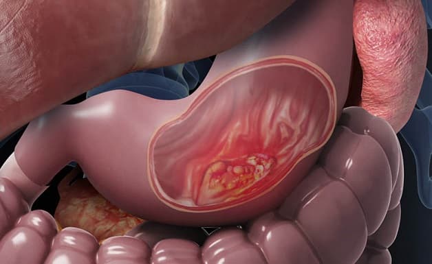 Viêm dạ dày có thể gây ra nhiều biến chứng nguy hiểm