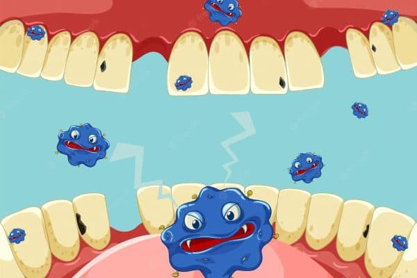 Vi khuẩn phát triển quá mức sẽ dẫn tới tình trạng viêm lợi, viêm chân răng...