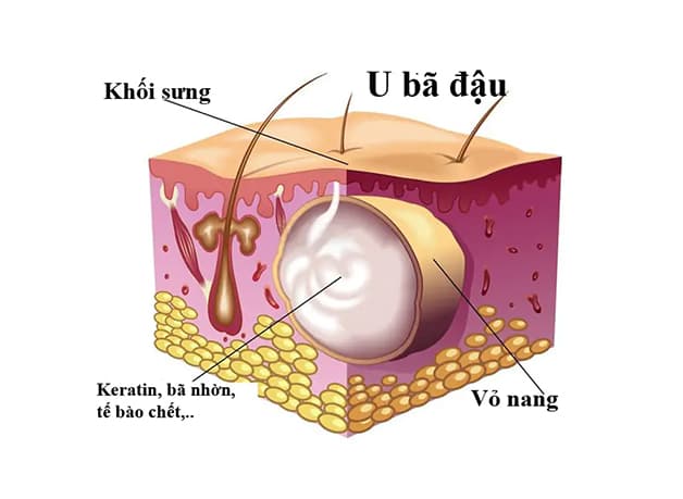 u bã đậu ở mí mắt