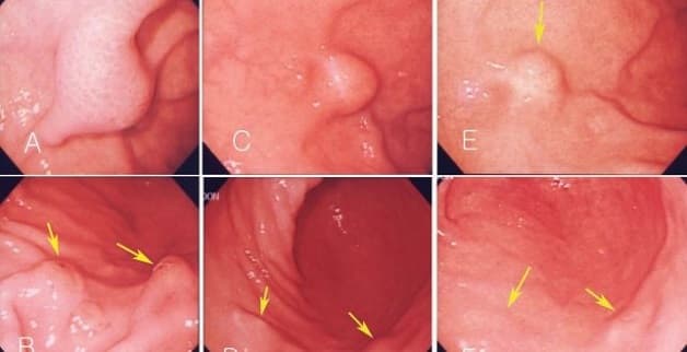 U dưới niêm mạc có nhiều loại khác nhau