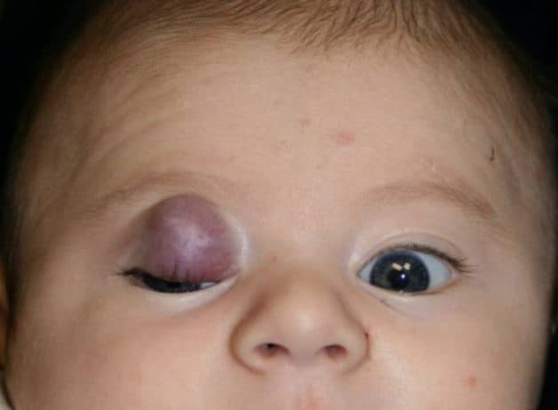 U mạch máu mí mắt là một dạng phổ biến của u mạch máu