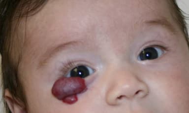 U mạch máu mí mắt và các phương pháp điều trị