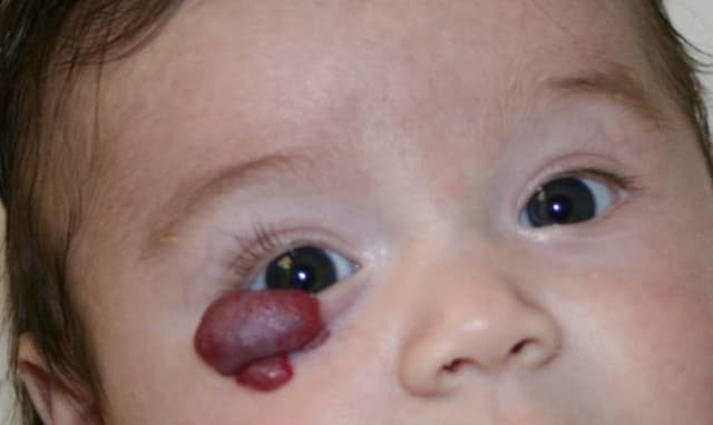 U mạch máu mí mắt và các phương pháp điều trị