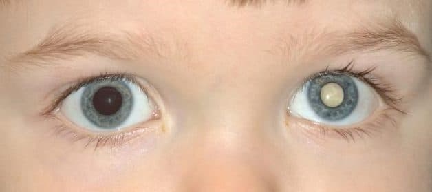 khái niệm u nguyên bào võng mạc ở trẻ