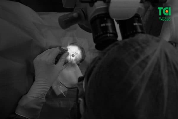 Phẫu thuật Phaco là kỹ thuật thay thế thủy tinh thể bị đục bằng công nghệ hiện đại