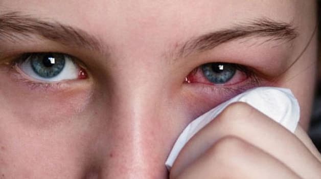 viêm kết mạc là gì