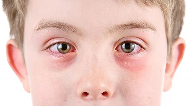 viêm kết mạc là gì