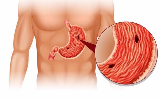 Viêm loét dạ dày là bệnh lý phổ biến 
