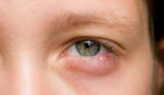 dấu hiệu viêm mí mắt dưới