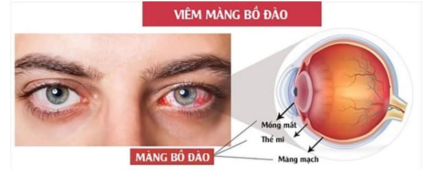 Viêm màng bồ đào là một trong những triệu chứng ngoài tiêu hóa xuất hiện ở người bệnh viêm đại tràng xuất huyết lâu năm