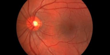 Giải đáp: Bệnh lý xuất huyết dịch kính có hết không?