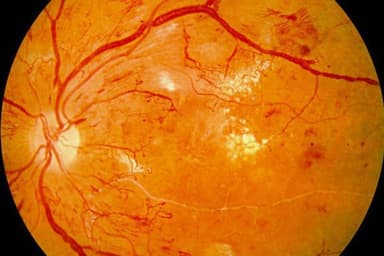 Giải đáp: Xuất huyết dịch kính có nguy hiểm không?