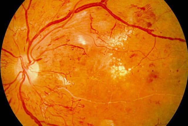 Giải đáp: Xuất huyết dịch kính có nguy hiểm không?