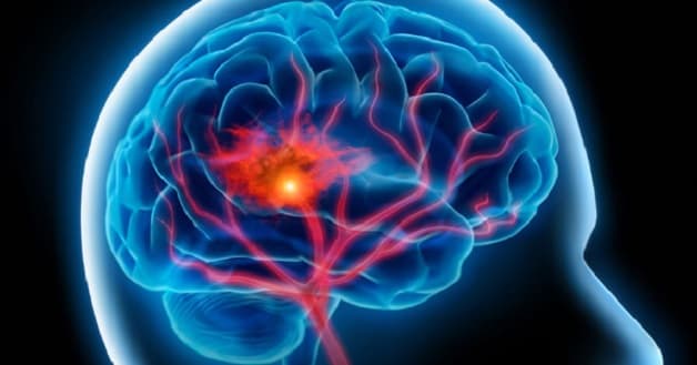 Xuất huyết nội sọ - Nguyên nhân dẫn đến tai biến mạch máu não