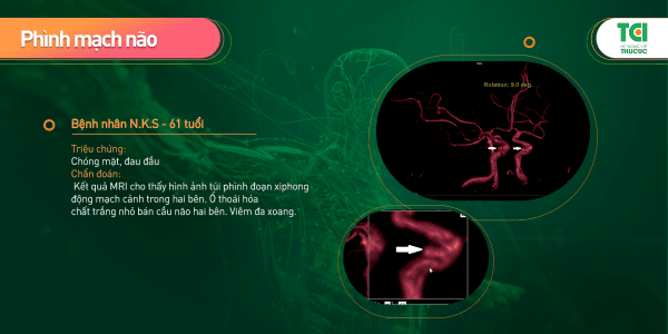 đau đầu chóng mặt do phình mạch não