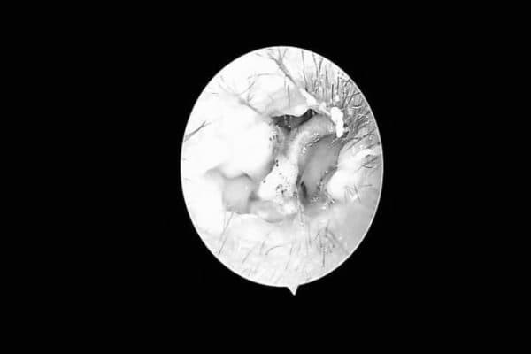 Khuẩn nấm bịt kín hốc tai bệnh nhân gây ù, ngứa, nghe kém. Ảnh: Bệnh viện cung cấp