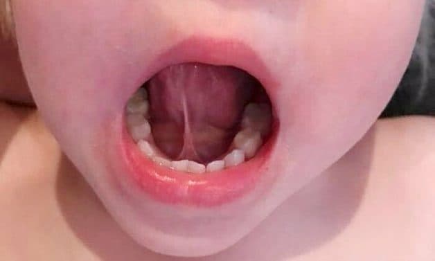 Khắc phục khi bé bị dính thắng lưỡi