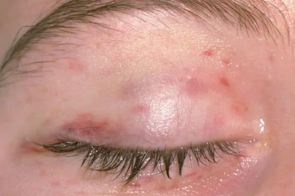 Nổi mẩn đỏ là tình trạng thường gặp ở trên da, thường gặp ở những người có cơ địa nhạy cảm