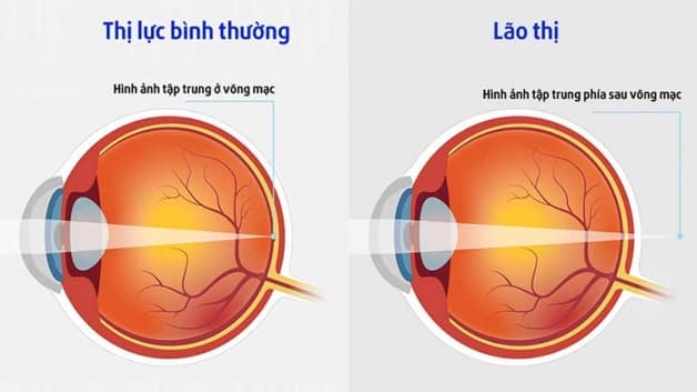 bệnh lão thị