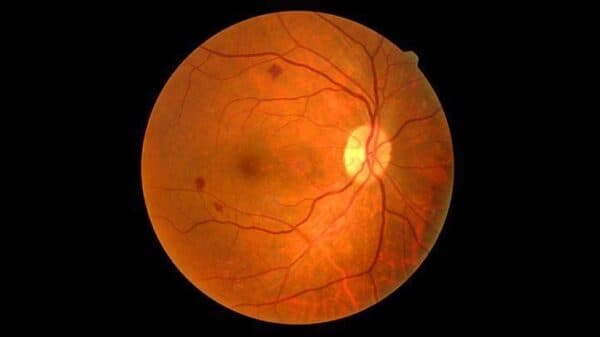 Bệnh phù hoàng điểm là gì theo các chuyên gia, đây là hậu quả của nhiều vấn đề khác nhau ở mắt