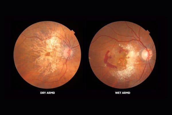 Thoái hoá điểm vàng do tuổi tác có thể là nguyên nhân gây phù hoàng điểm