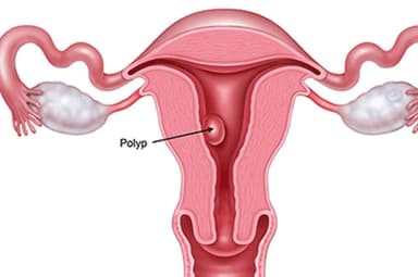 Chớ nên chủ quan với bệnh polyp tử cung ở phụ nữ
