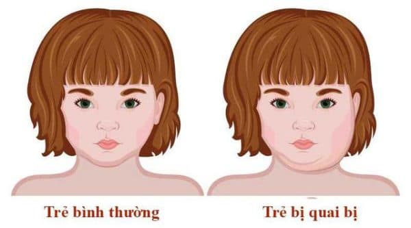 Quai bị là một bệnh lý nhiễm trùng do virus quai bị (Mumps virus) gây ra