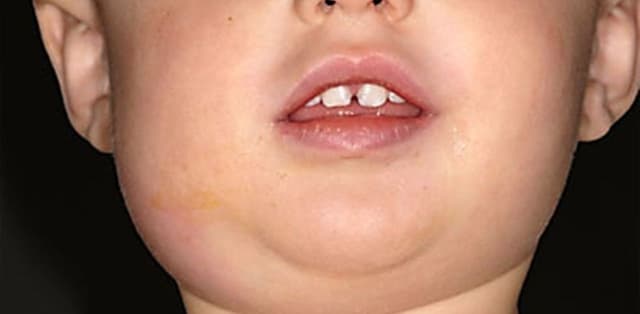 Bệnh quai bị uống thuốc gì?