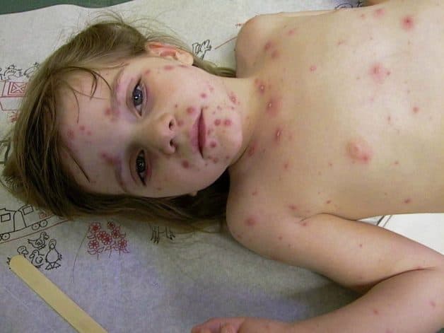 Dấu hiệu điển hình của thủy đậu là những mụn nước