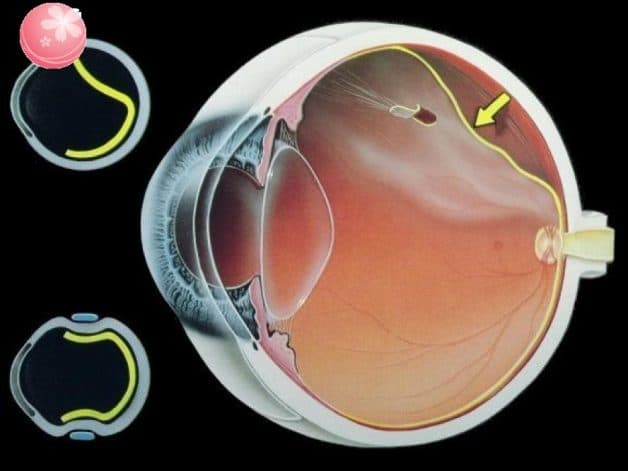 khái niệm bong võng mạc hoàn toàn