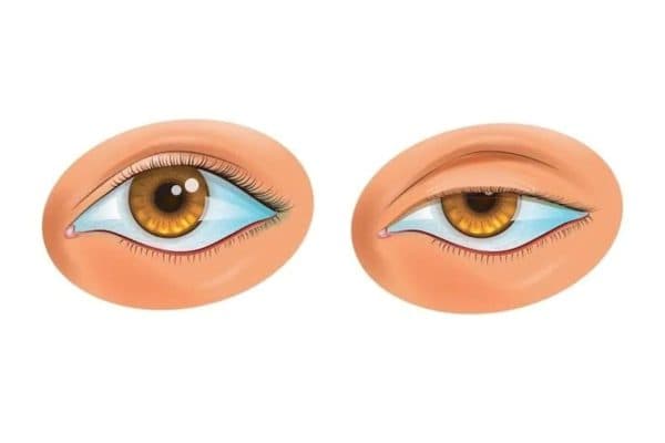 Sụp mí có thể dễ dàng nhận biết thông qua tình trạng mi mắt chùng xuống, chảy xệ