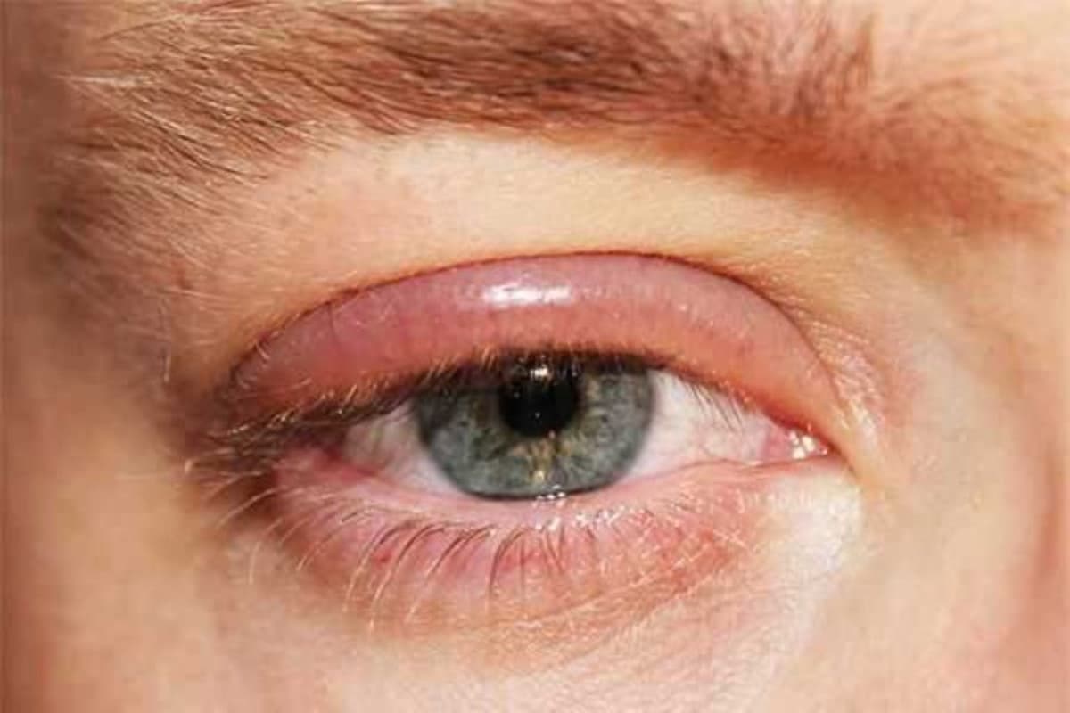 Bệnh viêm bờ mi liệu có nguy hiểm và cách chữa viêm bờ mi?