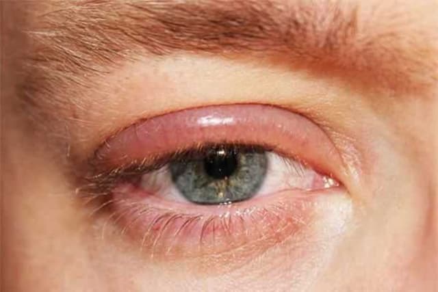 Bệnh viêm bờ mi liệu có nguy hiểm và cách chữa viêm bờ mi?