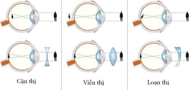 cách chữa viễn thị