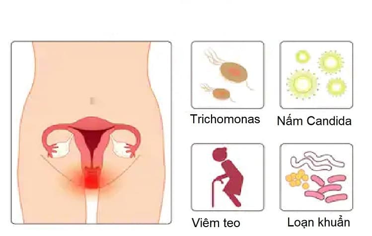 4 nguyên nhân phổ biến dẫn đến viêm âm đạo là do nấm, do vi khuẩn, do trichomonas và viêm teo âm đạo
