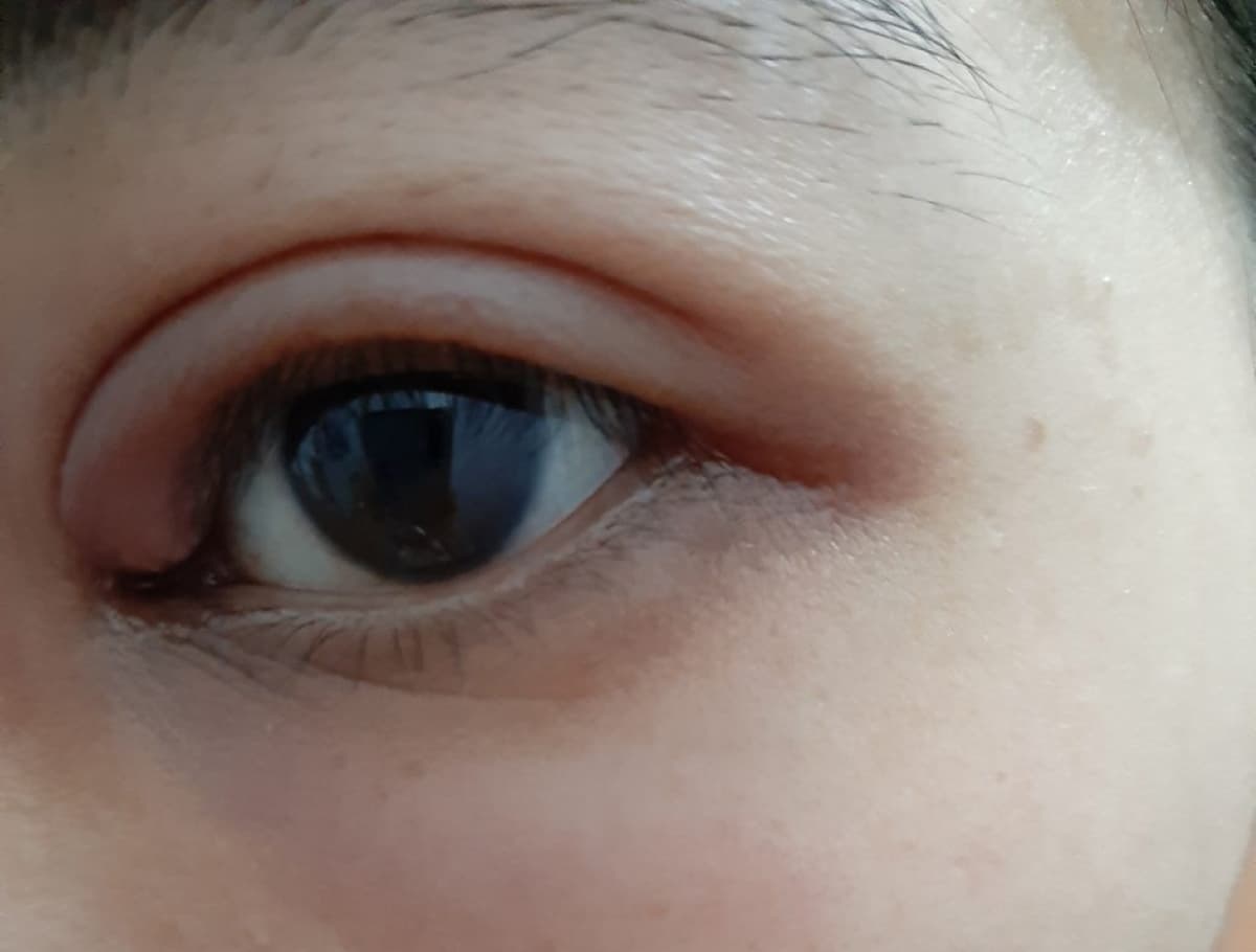 Chắp mắt bị vỡ có nguy hiểm không và cần làm những gì?