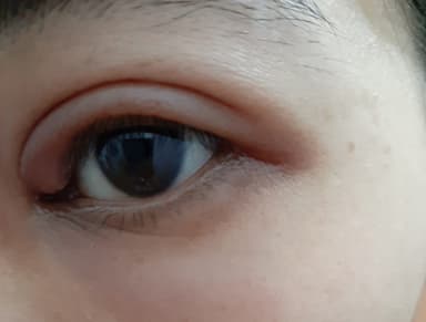 Chắp mắt bị vỡ có nguy hiểm không và cần làm những gì?