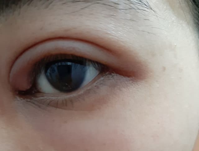 Chắp mắt bị vỡ có nguy hiểm không và cần làm những gì?